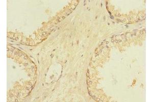 Immunohistochemistry of paraffin-embedded human prostate cancer using ABIN7175634 at dilution of 1:100 (VN1R5 抗体  (AA 185-269))