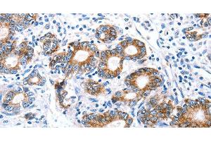 Immunohistochemistry of paraffin-embedded Human stomach cancer using Claudin 7 Polyclonal Antibody at dilution of 1:50 (Claudin 7 抗体)