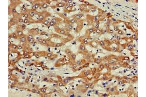 Immunohistochemistry of paraffin-embedded human liver cancer using ABIN7163167 at dilution of 1:100 (PIK3R2 抗体  (Regulatory Subunit beta))