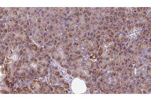 ABIN6273256 at 1/100 staining Human pancreas cancer tissue by IHC-P. (INSIG1 抗体  (Internal Region))