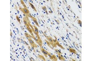 Immunohistochemistry of paraffin-embedded Human liver cancer using PLA2G2D Polyclonal Antibody at dilution of 1:100 (40x lens).