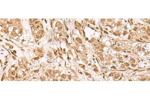 Immunohistochemistry of paraffin-embedded Human breast cancer tissue using BAP1 Polyclonal Antibody at dilution of 1:35(x200) (BAP1 抗体)