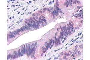 Anti-TNIK antibody IHC of human Pancreas, Carcinoma. (TNIK 抗体  (Internal Region))