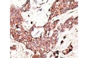 IHC analysis of FFPE human breast carcinoma tissue stained with the SIRT3 antibody (SIRT3 抗体  (AA 250-279))