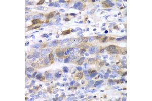Immunohistochemistry of paraffin-embedded human gastric cancer using UBE2C antibody (ABIN5973207) at dilution of 1/100 (40x lens). (UBE2C 抗体)