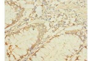 Immunohistochemistry of paraffin-embedded human colon cancer using ABIN7145384 at dilution of 1:100 (B4GALNT2 抗体  (AA 301-566))