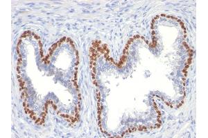 Formalin-fixed, paraffin-embedded human Prostate Cancer stained with p63 Mouse Monoclonal Antibody (TP63/11). (p63 抗体)