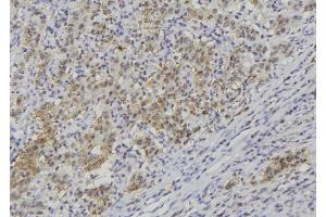 ABIN6278844 at 1/100 staining Human lung cancer tissue by IHC-P. (CRLF1 抗体)