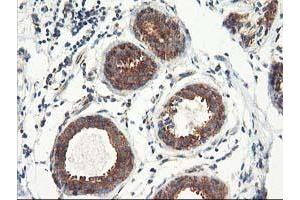 Immunohistochemical staining of paraffin-embedded Human breast tissue using anti-TFG mouse monoclonal antibody. (TFG 抗体)