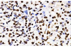 Immunohistochemistry of paraffin-embedded Human kidney cancer using DiMethyl-Histone H3-K4 Polyclonal Antibody at dilution of 1:200 (40x lens). (Histone 3 抗体  (2meLys4))