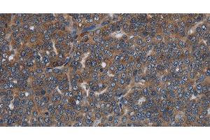 Immunohistochemistry of paraffin-embedded Human ovarian cancer tissue using LETMD1 Polyclonal Antibody at dilution 1:30 (LETMD1 抗体)