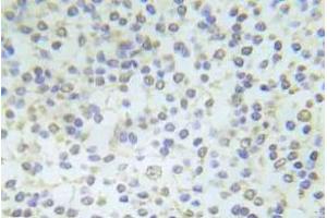 Immunohistochemistry (IHC) analyzes of p-Abl1 antibody in paraffin-embedded human breast carcinoma tissue. (ABL1 抗体  (pTyr204))