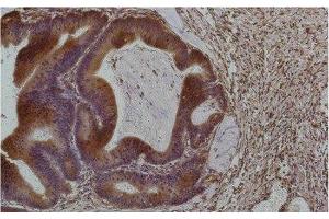 Immunohistochemistry of paraffin-embedded Human colon carcinoma tissue using Smad3 Monoclonal Antibody at dilution of 1:200. (SMAD3 抗体)