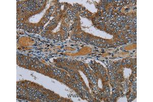 Immunohistochemistry of Human colon cancer using PCK2 Polyclonal Antibody at dilution of 1:60 (PEPCK 抗体)
