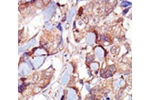 IHC analysis of FFPE human breast carcinoma tissue stained with the MYLK3 antibody (MYLK3 抗体  (AA 40-69))