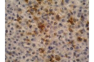 Immunohistochemistry staining of hepatocellular carcinoma (fetal liver, paraffin-embedded sections) with anti-human alpha-Fetoprotein (AFP-11). (alpha Fetoprotein 抗体)