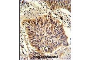Formalin-fixed and paraffin-embedded human lung carcinoma with GOLPH3 Antibody (C-term), which was peroxidase-conjugated to the secondary antibody, followed by DAB staining. (GOLPH3 抗体  (C-Term))