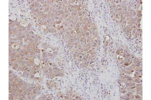 IHC-P Image Immunohistochemical analysis of paraffin-embedded AdCA xenograft, using RPL3, antibody at 1:100 dilution. (RPL3 抗体)