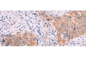 Immunohistochemistry of paraffin-embedded Human cervical cancer tissue using GSPT2 Polyclonal Antibody at dilution of 1:50(x200) (GSPT2 抗体)