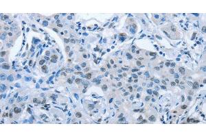 Immunohistochemistry of paraffin-embedded Human lung cancer tissue using ARHGEF2 Polyclonal Antibody at dilution 1:30 (ARHGEF2 抗体)
