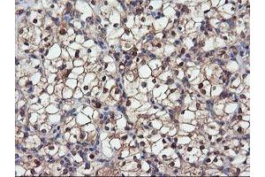 Immunohistochemical staining of paraffin-embedded Carcinoma of Human kidney tissue using anti-DPP9 mouse monoclonal antibody. (DPP9 抗体)