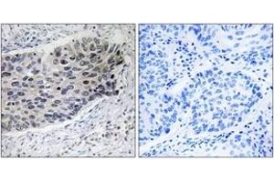 Immunohistochemistry analysis of paraffin-embedded human lung carcinoma tissue, using PC Antibody. (PC (AA 357-406) 抗体)