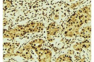 ABIN6276603 at 1/100 staining Human breast cancer tissue by IHC-P. (RASSF1 抗体  (Internal Region))