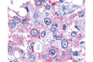 Anti-F2RL1 / PAR2 antibody IHC of human Breast, Carcinoma. (F2RL1 抗体  (N-Term))