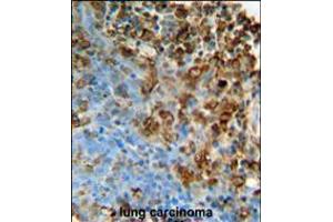 ITPA Antibody immunohistochemistry analysis in formalin fixed and paraffin embedded human lung carcinoma followed by peroxidase conjugation of the secondary antibody and DAB staining. (ITPA 抗体  (N-Term))