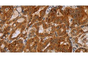 Immunohistochemistry of paraffin-embedded Human thyroid cancer tissue using MTUS1 Polyclonal Antibody at dilution 1:40 (MTUS1 抗体)