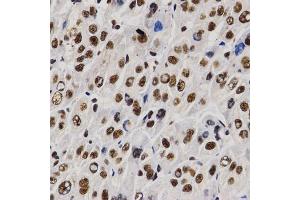 Immunohistochemistry of paraffin-embedded human liver cancer using PELP1 antibody (ABIN6292223) at dilution of 1:200 (40x lens). (PELP1 抗体)
