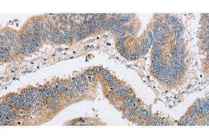 Immunohistochemistry of paraffin-embedded Human colon cancer using ARHGEF9 Polyclonal Antibody at dilution of 1:50 (Arhgef9 抗体)