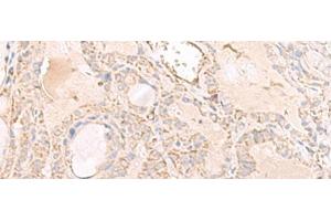 Immunohistochemistry of paraffin-embedded Human thyroid cancer tissue using IGHA1 Polyclonal Antibody at dilution of 1:65(x200) (IGHA1 抗体)