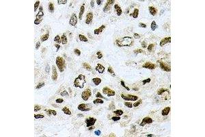 Immunohistochemical analysis of SAP145 staining in human lung cancer formalin fixed paraffin embedded tissue section. (SF3B2 抗体)