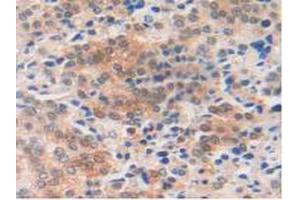 IHC-P analysis of Human Prostate Gland Cancer Tissue, with DAB staining. (MIF 抗体  (AA 3-111))