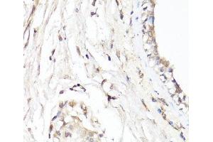 Immunohistochemistry of paraffin-embedded Human breast using CDK7 Polyclonal Antibody at dilution of 1:150 (40x lens). (CDK7 抗体)