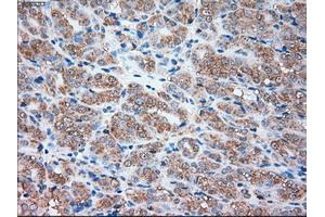 Immunohistochemical staining of paraffin-embedded Carcinoma of liver tissue using anti-SIGLEC9mouse monoclonal antibody. (SIGLEC9 抗体)