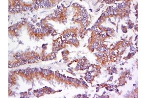 Formalin-fixed and paraffin embedded human lung carcinoma labeled with Anti-AMPK beta 1 Polyclonal Antibody, Unconjugated  at 1:200 followed by conjugation to the secondary antibody and DAB staining. (PRKAB1 抗体  (AA 2-100))