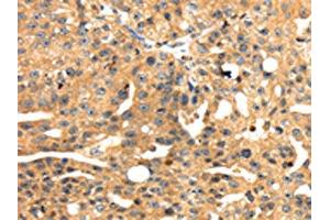 The image on the left is immunohistochemistry of paraffin-embedded Human breast cancer tissue using ABIN7131050(SH3KBP1 Antibody) at dilution 1/45, on the right is treated with fusion protein. (SH3KBP1 抗体)