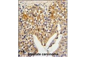 Formalin-fixed and paraffin-embedded human prostate carcinoma reacted with LUM Antibody (N-term), which was peroxidase-conjugated to the secondary antibody, followed by DAB staining. (LUM 抗体  (N-Term))