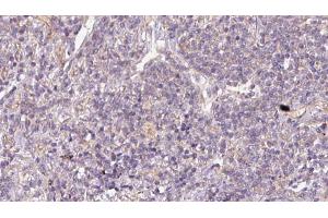 ABIN6273170 at 1/100 staining Human lymph cancer tissue by IHC-P. (STBD1 抗体  (N-Term))