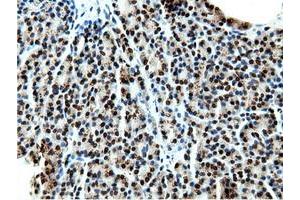 Immunohistochemical staining of paraffin-embedded Carcinoma of Human kidney tissue using anti-NT5DC1 mouse monoclonal antibody. (NT5DC1 抗体)