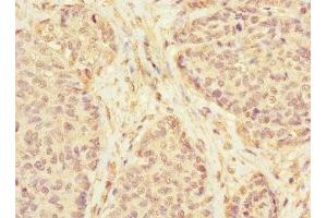 Immunohistochemistry of paraffin-embedded human ovarian cancer using ABIN7157271 at dilution of 1:100 (KLHL13 抗体  (AA 1-260))