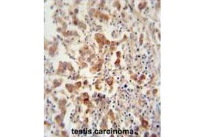 TEX13B antibody (C-term) immunohistochemistry analysis in formalin fixed and paraffin embedded human testis carcinoma followed by peroxidase conjugation of the secondary antibody and DAB staining. (TEX13B 抗体  (C-Term))