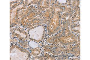 Immunohistochemistry of Human breast cancer using PTPN4 Polyclonal Antibody at dilution of 1:40 (PTPN4 抗体)
