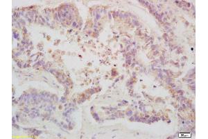 Formalin-fixed and paraffin embedded human colon carcinoma labeled with Anti-Phospho-TBK1/NAK (Ser172) Polyclonal Antibody, Unconjugated (ABIN746363) at 1:200 followed by conjugation to the secondary antibody and DAB staining (TBK1 抗体  (pSer172))