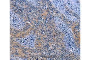 Immunohistochemistry of Human cervical cancer using NEK8 Polyclonal Antibody at dilution of 1:30 (NEK8 抗体)