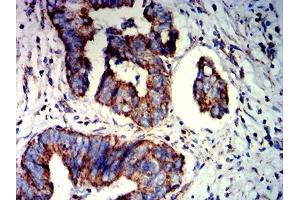 Immunohistochemical analysis of paraffin-embedded rectum cancer tissues using PAX8 mouse mAb with DAB staining. (PAX8 抗体  (AA 60-261))