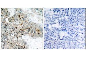 Immunohistochemical analysis of paraffin-embedded human breast carcinoma tissue using Integrin β3 (phospho-Tyr773) antibody (E011060). (Integrin beta 3 抗体  (pTyr773))