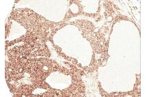 IHC-P Image Immunohistochemical analysis of paraffin-embedded Hepatocellular carcinoma Huh7 xenograft, using AGT, antibody at 1:100 dilution. (AGT 抗体)